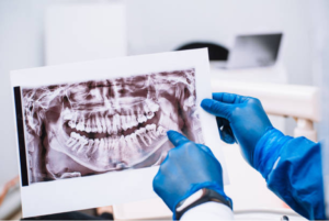 Doctor pointing to an x-ray of a mouth Oral Surgeon Near Me